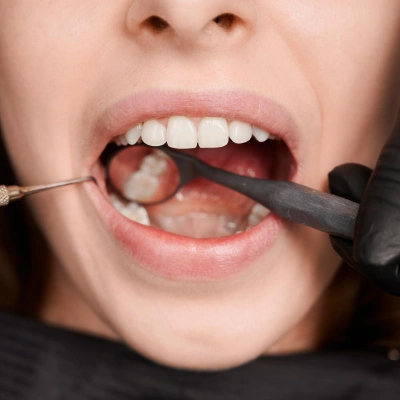 Specialized extraction of impacted wisdom teeth